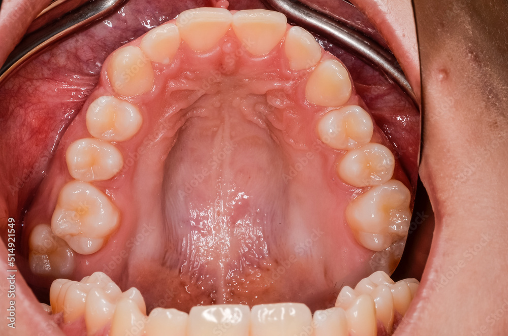 Obraz premium upper jaw with healthy teeth
