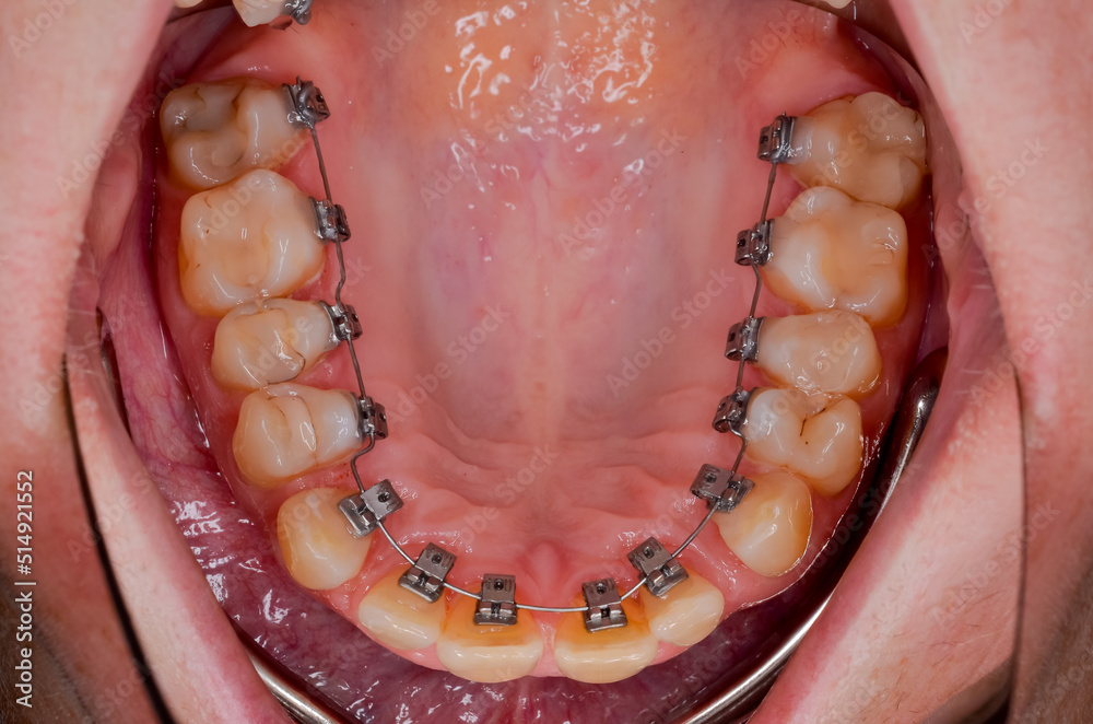 lingual orthodontics