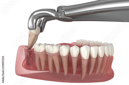 Extraction of wisdom tooth. Medically accurate tooth 3D illustration.
