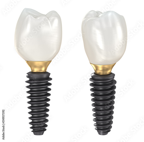 Dental implant and ceramic crown. Medically accurate tooth 3D illustration.