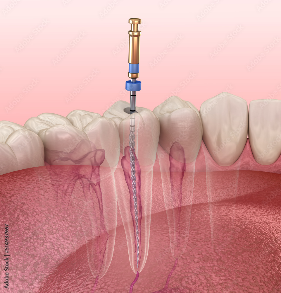 Endodontic root canal treatment process. Medically accurate tooth 3D  illustration. Stock Illustration