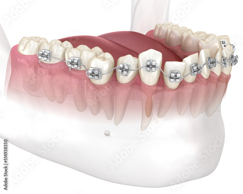 Abnormal teeth position and correction with metal braces tretament. Medically accurate dental 3D illustration