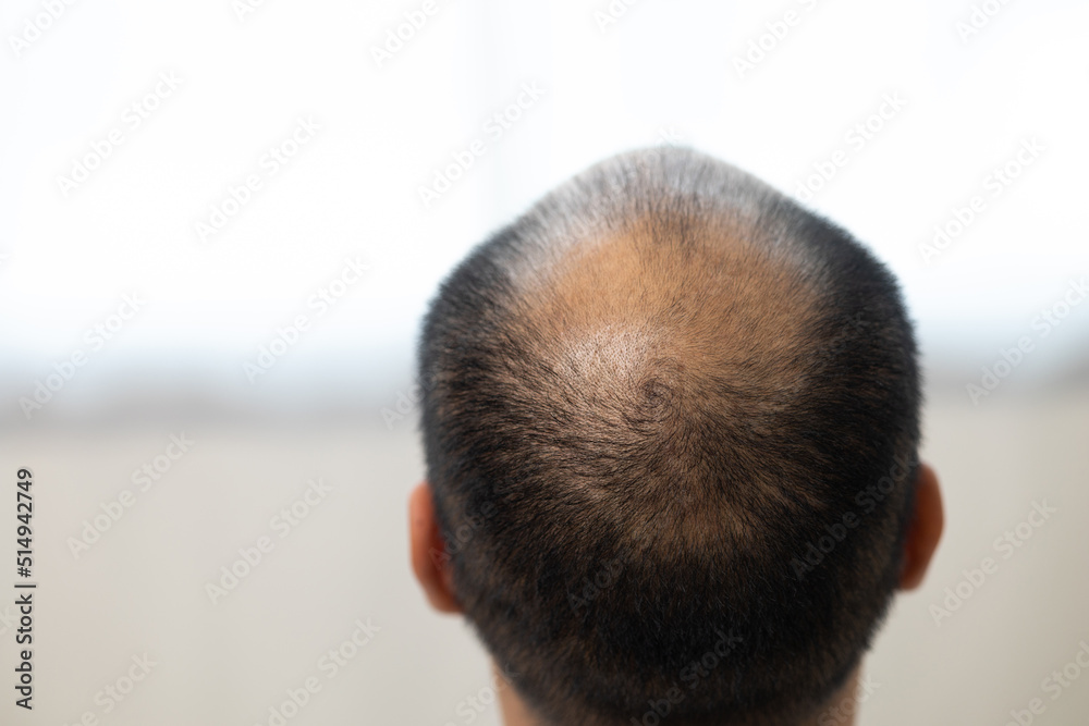 Close up man hair loss. Young man itchy head There is a fungus on the scalp