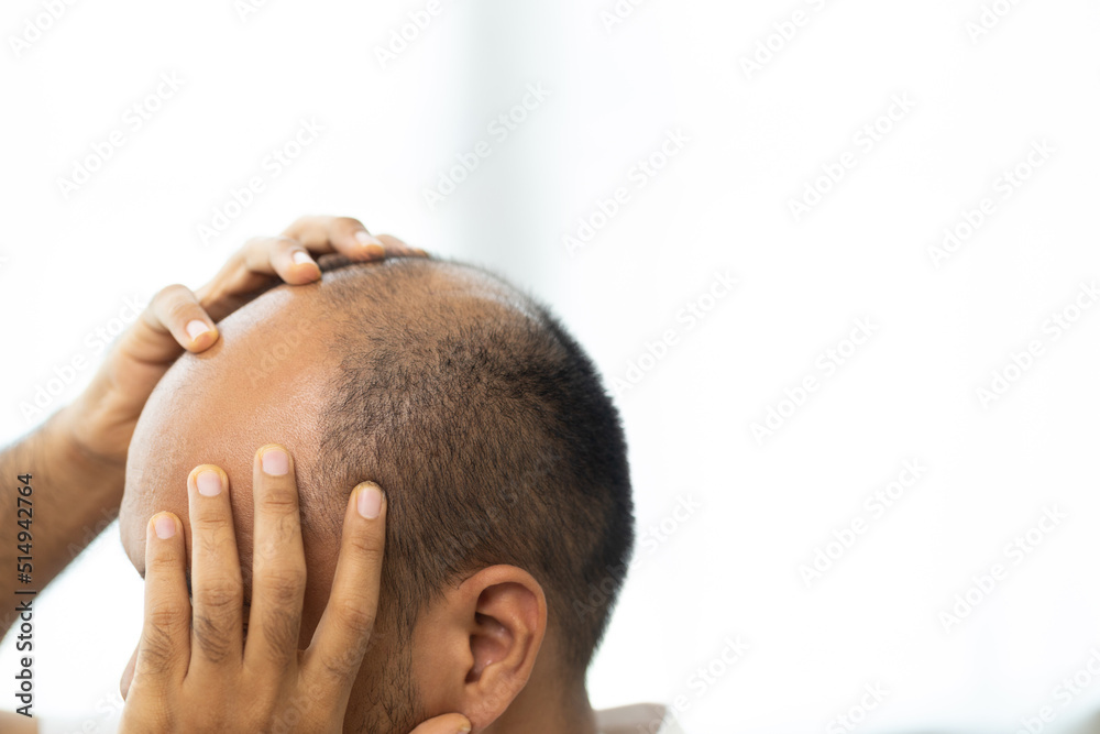 Close up man hair loss. Young man itchy head There is a fungus on the