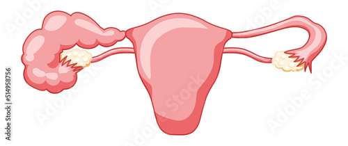 Hydrosalpinx Female reproductive system blocked fallopian tube uterus with description text. Human anatomy internal organs vector medical illustration flat style icon isolated on white background