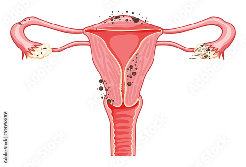 Endometriosis stages Female reproductive system pain uterus. Front view. Human anatomy internal organs location scheme flat style icon vector illustration Realistic flat color concept isolated white photo