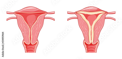 Set of Endometrial hyperplasia Female reproductive system in normal and problem uterus. Front view in a cut. Human anatomy internal organs diseases location scheme flat style icon photo