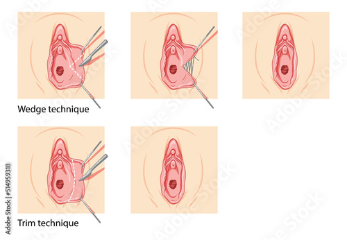 Labiaplasty Female reproductive system process and ready uterus. Vaginoplasty Front view. Human Surface anatomy of the perineum external organs location scheme, vagina pain vulva flat style icon photo