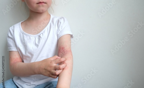 The child scratches atopic skin. Dermatitis, diathesis, allergy on the child's body. photo