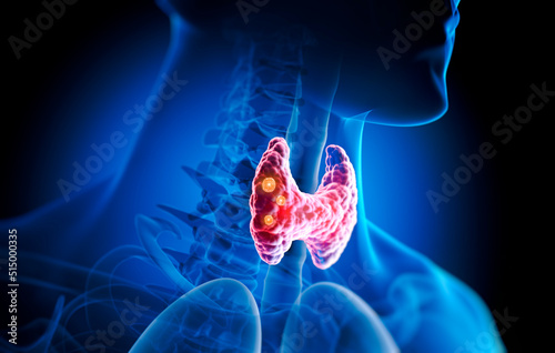 Thyroid gland with nodules inside human body - 3D illustration photo