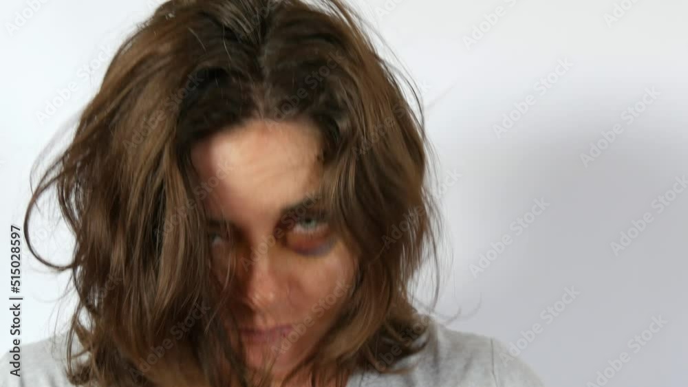 Large real bruise hematoma under eye of young woman, purple bruise. Broken lip and forehead wound. terrified face of domestic violence victim. Woman touching her tousled hair Large real bruise hematoma under eye of young woman, purple bruise. Broken lip and forehead wound. terrified face of domestic violence victim. Woman touching her tousled hair