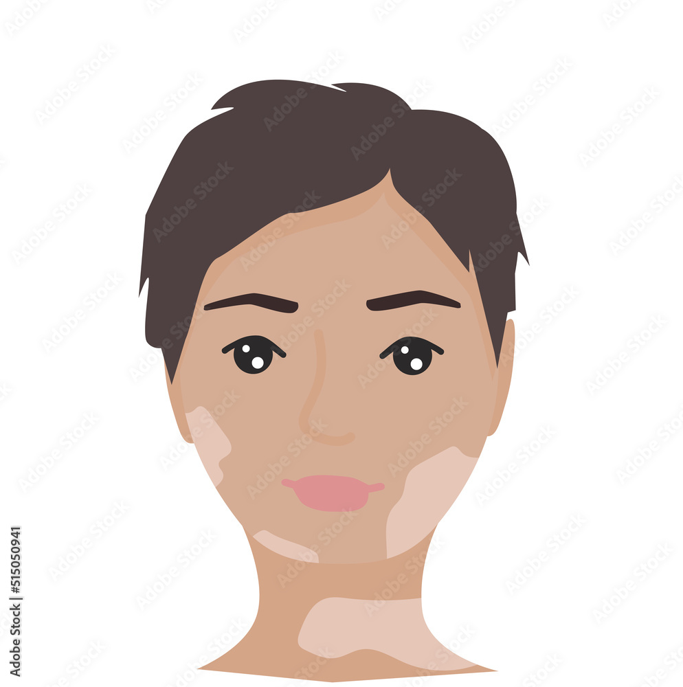 Portrait of female with vitiligo. Self acceptance, self love concept. Poster, banner, card World Vitiligo Day Portrait of female with vitiligo. Self acceptance, self love concept. Poster, banner, card World Vitiligo Day
