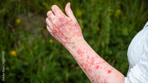 Elderly woman suffering from a severe case of sun allergy on her arm. Typically the skin becomes itchy and red, and when exposed to sunlight for too long rashes and blisters develops. 