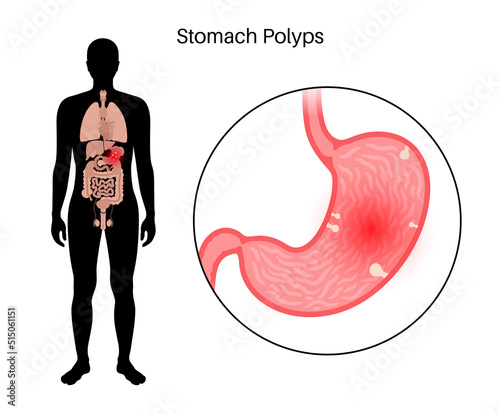 Stomach polyp disease