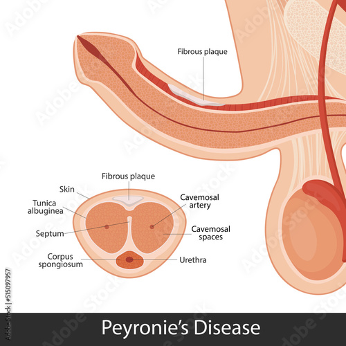 Peyronie disease. male reproductive system. penis medical vector illustration.