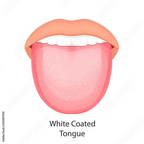 Anatomy of the oral cavity. Vector illustration of tongue with white coating.