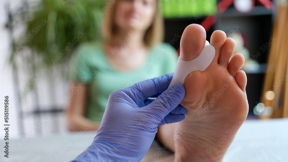 Doctor orthopedist examining leg with hallux valgus deformity of first toe - obrazy, fototapety, plakaty 