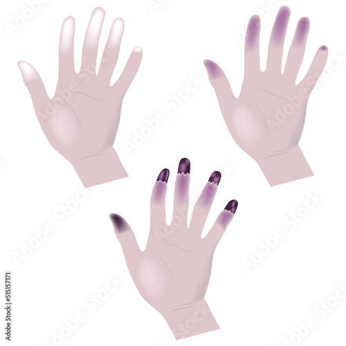 vibration syndrome. Hand injury with stages. Medical poster. Vector illustration