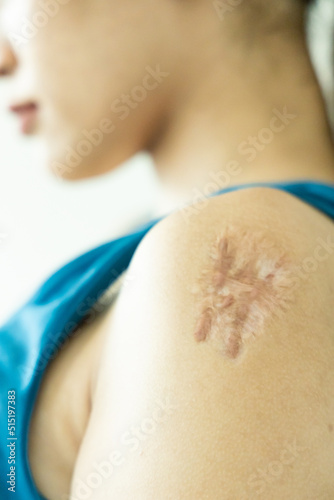 Woman having large hypertrophic scar on her left upper arm due to injury or vaccination adverse side effect