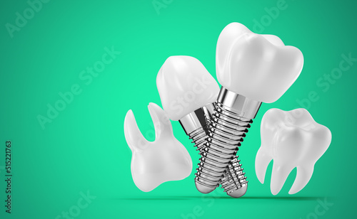 dental implants on a green background. 3d rendering, 3d illustration