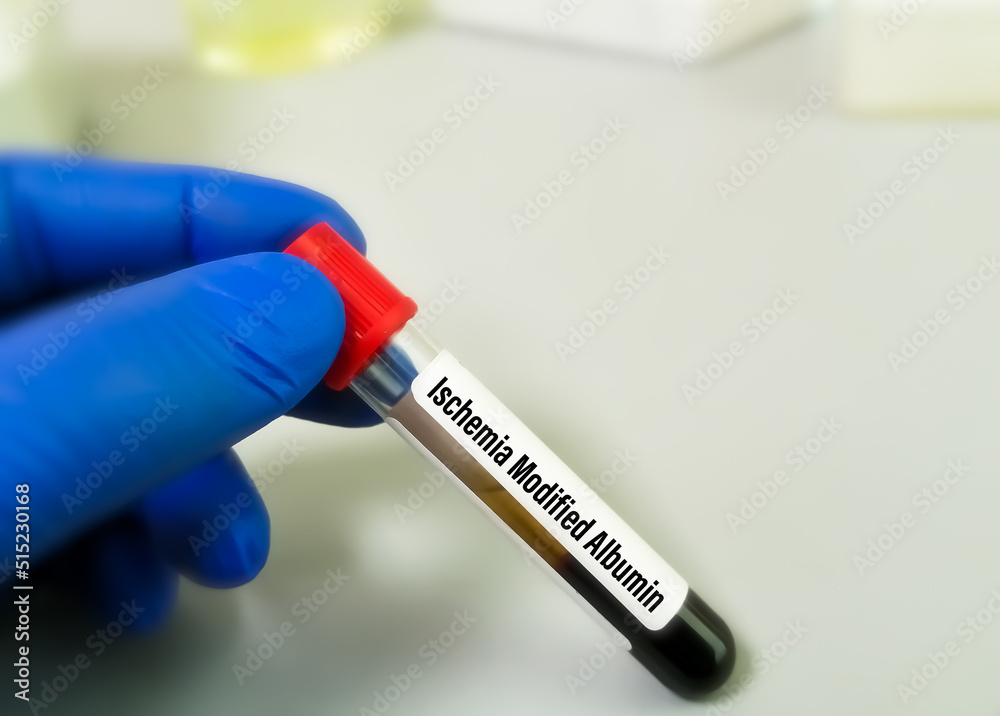Blood sample for Ischemia modified albumin (IMA) test, a marker of