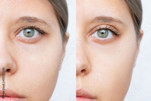 Cropped shot of young caucasian woman's face with drooping upper eyelid before and after plastic surgery isolated on white background. Result of blepharoplasty. Changing the shape, cut of the eyes photo