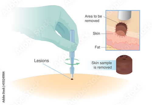 Removed a sample of skin with the Biopsy punches tool. Cut small tissue of the patient for for diagnosis and skin cancer treatment.