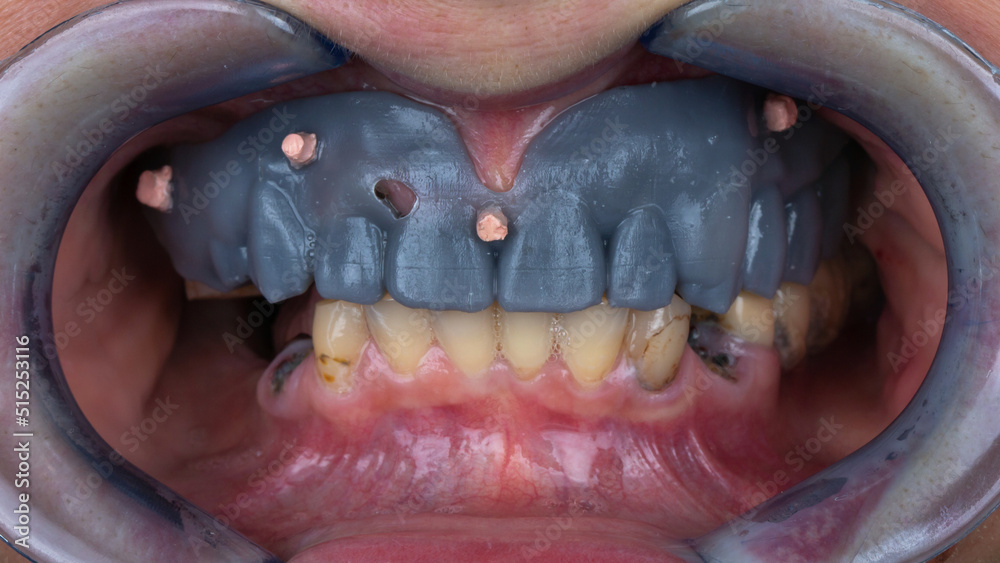 Obraz premium printed mock-up of the future prosthesis on the upper jaw before implantation