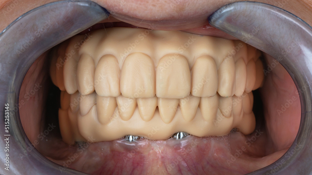 dental mockup of the upper and lower jaws for future implantation and