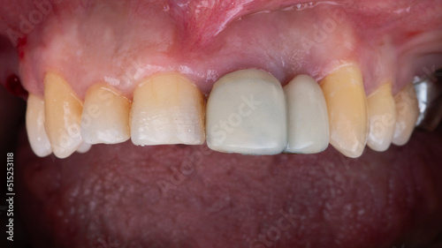 failed or damaged crowns of the two central teeth before extraction