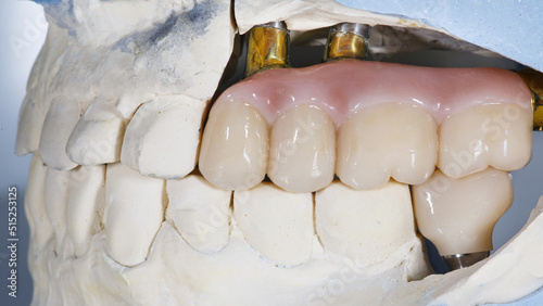 dental bridge prosthesis with a gum on a titanium beam and one crown on the model in the occlusion