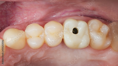 installed dental crown of the chewing tooth before closing the screw shaft
