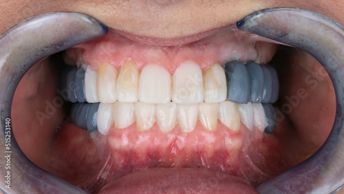 mock-up of prosthesis bridges for posterior teeth in the jaw bite