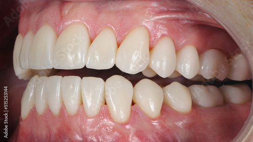two jaws with crowns and ceramic veneers, side view