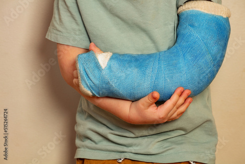 Close-up of a broken hand blue plaster cast after accident