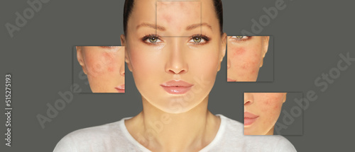 Acne,Skin concern,blemish-prone skin and acne, Rosacea,different types of acne photo