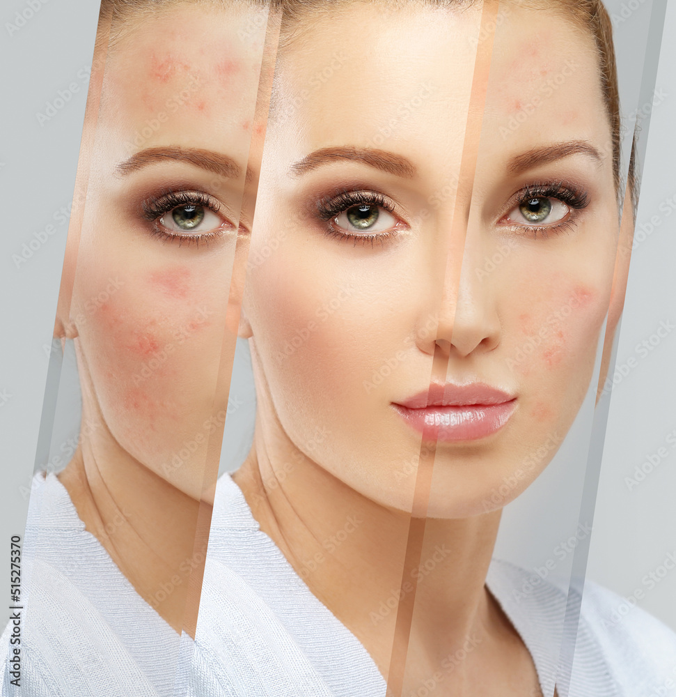 Acne,Skin concern,blemishprone skin and acne, Rosacea,different types