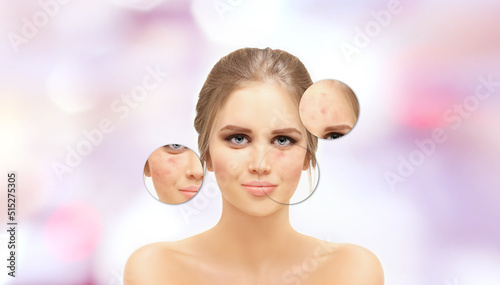 Acne,Skin concern,blemish-prone skin and acne, Rosacea,different types of acne photo