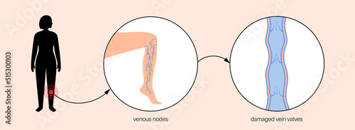 Varicose veins treatment photo