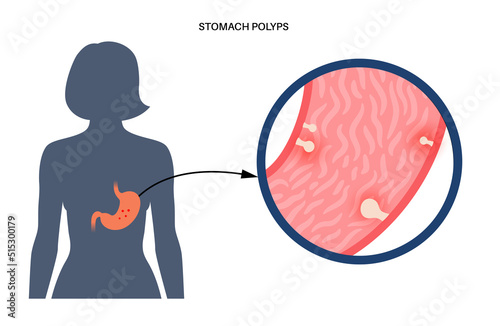Stomach polyp disease