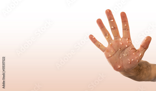 monkeypox. Man with blisters on his hands from monkeypox. blank background.