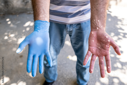 hands affected by smallpox. man wearing gloves to protect from monkey virus.