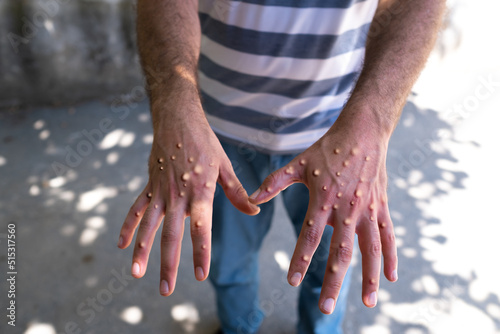 infected with monkeypox. Man with blisters on his hands from monkeypox.