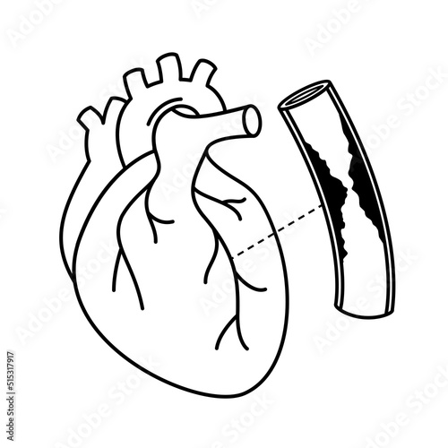 Human heart with Coronary Artery Disease. Outline info graphic. Blocked artery, heart awareness concept. Vector illustration.