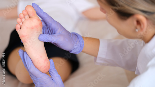 Doctor examining foot of child with red itchy rashes in clinic closeup photo
