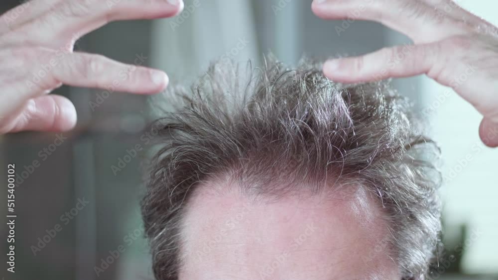 Thinning hair, the problem of hair loss and alopecia. Guy's crazy haircut. Thinning hair, the problem of hair loss and alopecia. Guy's crazy haircut.