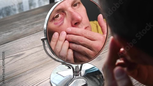 A man examines a bruise and a hematoma on his face next to his eye in the mirror.