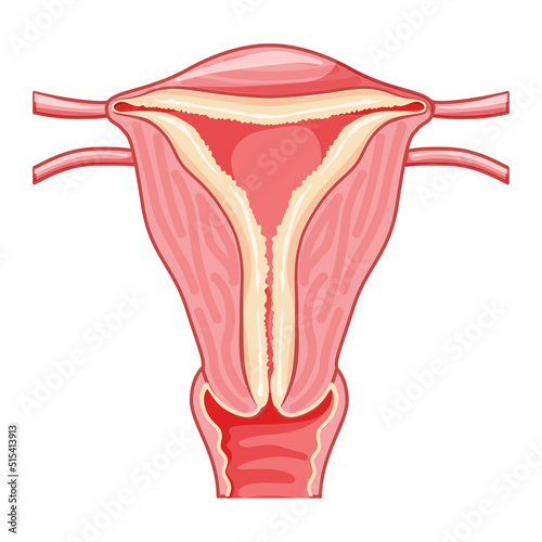 Set of Endometrial hyperplasia Female reproductive system uterus with thick endometrium layer. Front view in a cut. Human anatomy internal organs diseases location scheme flat style icon