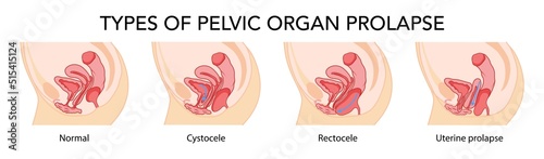 Set of Prolapses types pelvic organ cystocele, uterine, rectocele. Female reproductive system uterus. Human anatomy internal organs location scheme flat. Vector medical illustration concept isolated photo