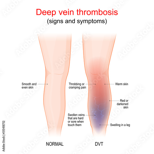 deep vein thrombosis. Healthy leg, and leg with DVT. Sign and symptoms photo